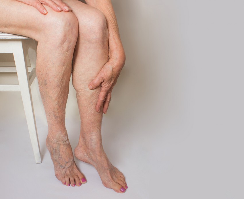 Варикозное расширение вен на ногах симптомы и лечение картинки