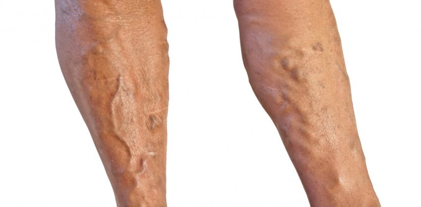 Фото варикозное расширение вен на ногах симптомы и лечение фото