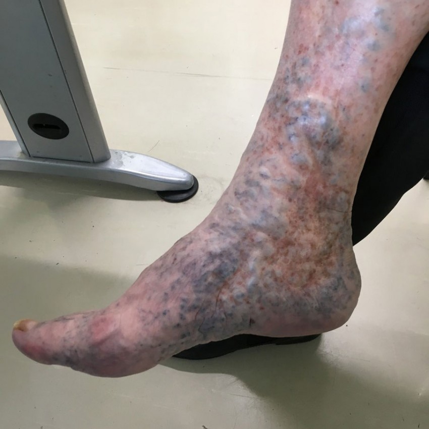 Варикозная болезнь ног фото