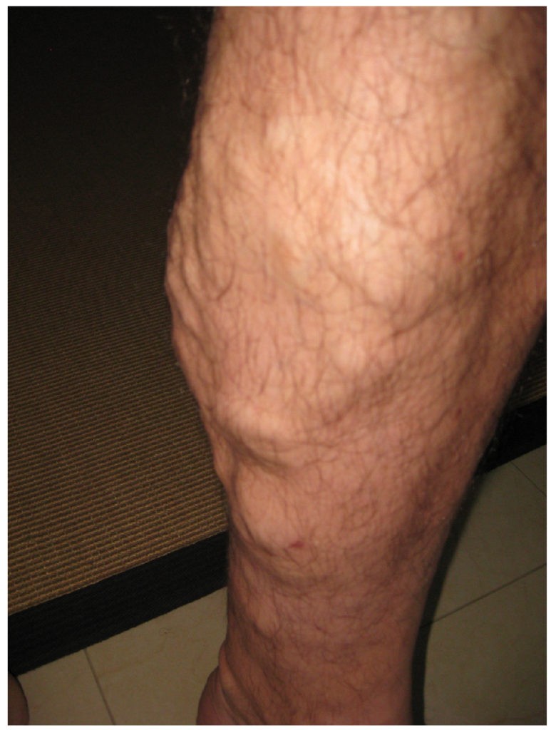 Варикозное расширение вен ног симптомы фото