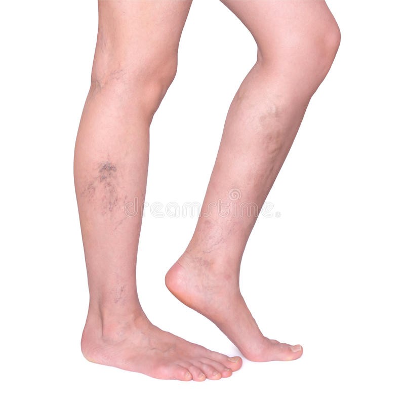 Признаки варикозного расширения вен на ногах фото