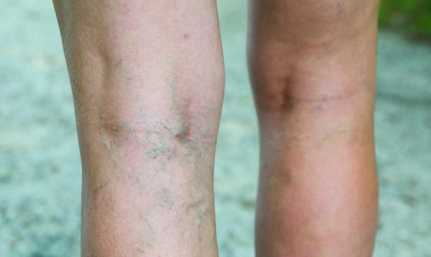 Что такое варикозное расширение вен на ногах фото причины
