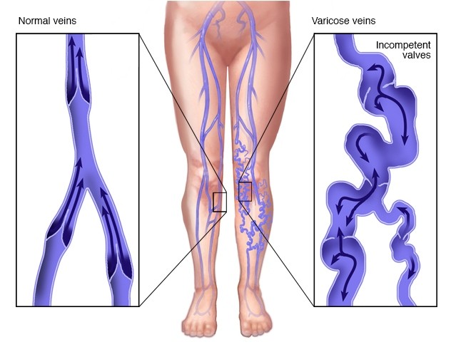 Варикозное расширение вен на ногах симптомы и лечение картинки