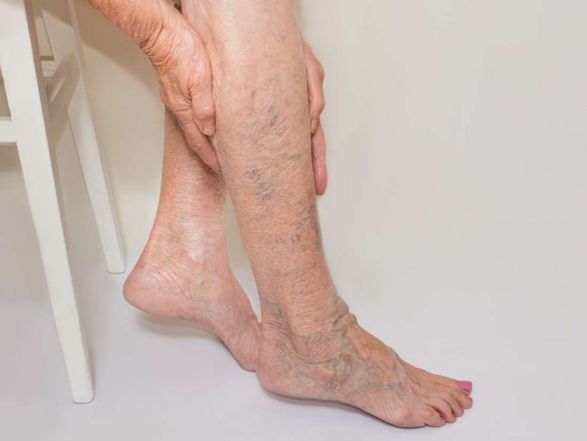Варикозное расширение вен на ногах лечение фото