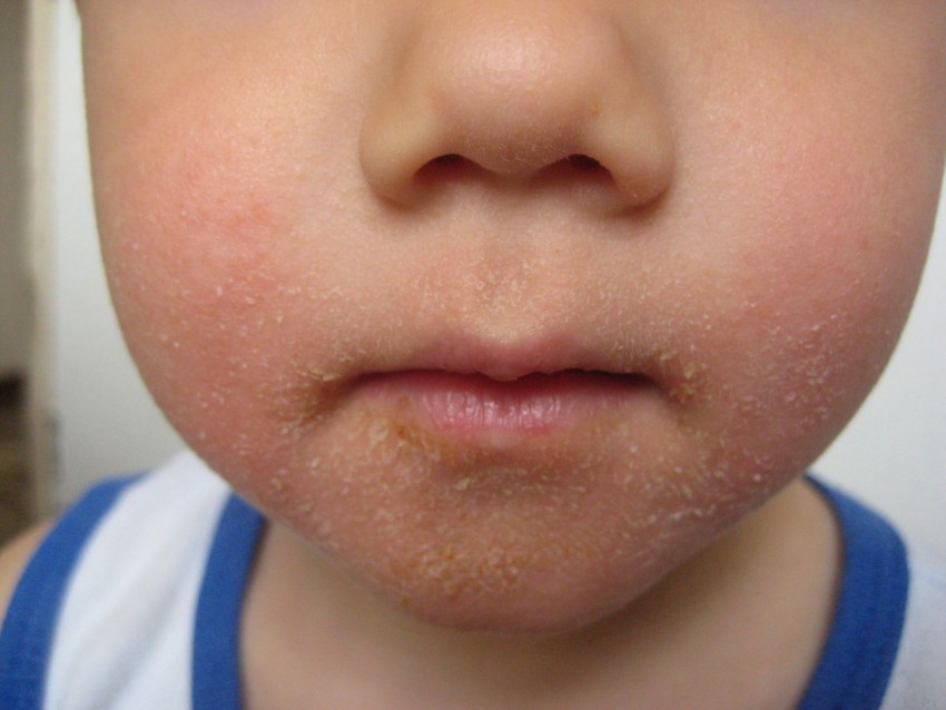 Первые признаки аллергии у ребенка фото thumbnail