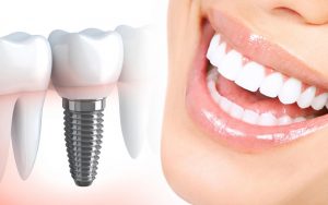 Имплантация зубов: инновационное протезирование